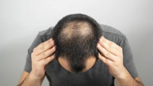 انحسار شعر الرأس... المراحل والتشخيص وخيارات العلاج