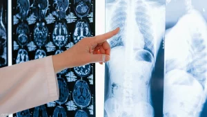 علاجات حديثة تزيد فرص النجاة من سرطان الرئة عالميا
